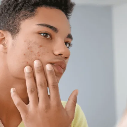 The Best Treatments for Acne and Skin Imperfections